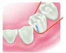 Illustration - Zahnseide um einzelne Zähne schleifen