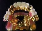Vergoldeter herausnehmbarer Zahnersatz